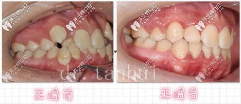 北京維樂(lè)口腔正畸案例