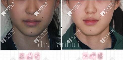 北京維樂(lè)口腔金屬托槽矯正案例