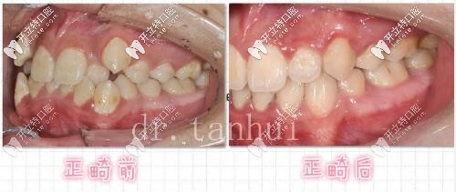 北京維樂(lè)口腔正畸案例 側(cè)面