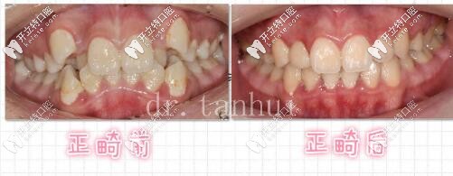 北京維樂(lè)口腔骨性一類錯(cuò)頜畸形矯治案例