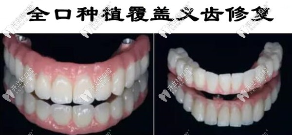 Locator種植覆蓋義齒的費(fèi)用和圖片,送給全口無牙頜的伙計(jì)們
