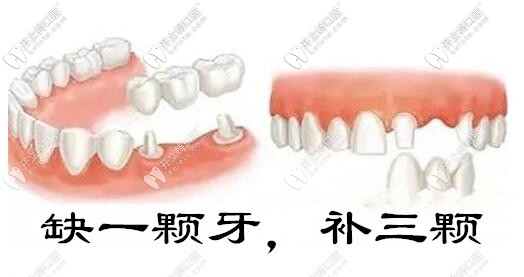 做全瓷牙和烤瓷牙缺一補(bǔ)三