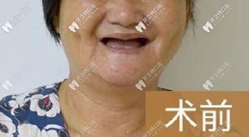 我在貴陽種植全口牙用了8顆德國ICX植體,價(jià)錢也沒想象的貴