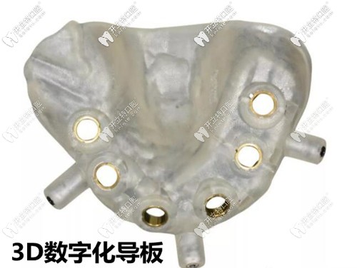 福州維樂口腔3D導(dǎo)板種植牙技術(shù)