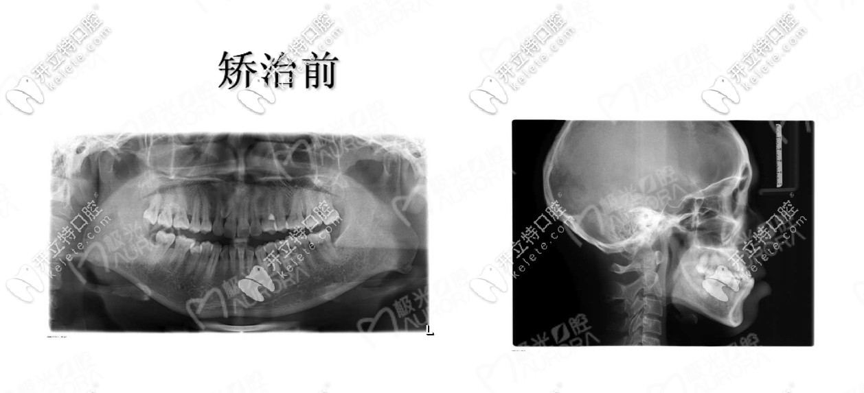 門牙地包天怎么矯正