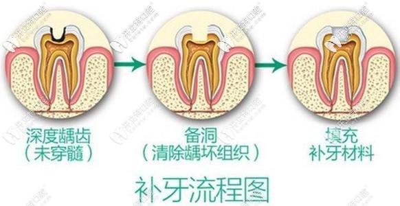 蛀牙別拖久喲!偷偷告訴你杭州做3M樹脂補(bǔ)牙的價格在這！