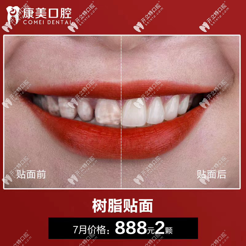 樹(shù)脂貼面888元2顆