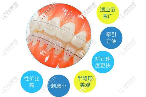 半隱形矯正優(yōu)點(diǎn)