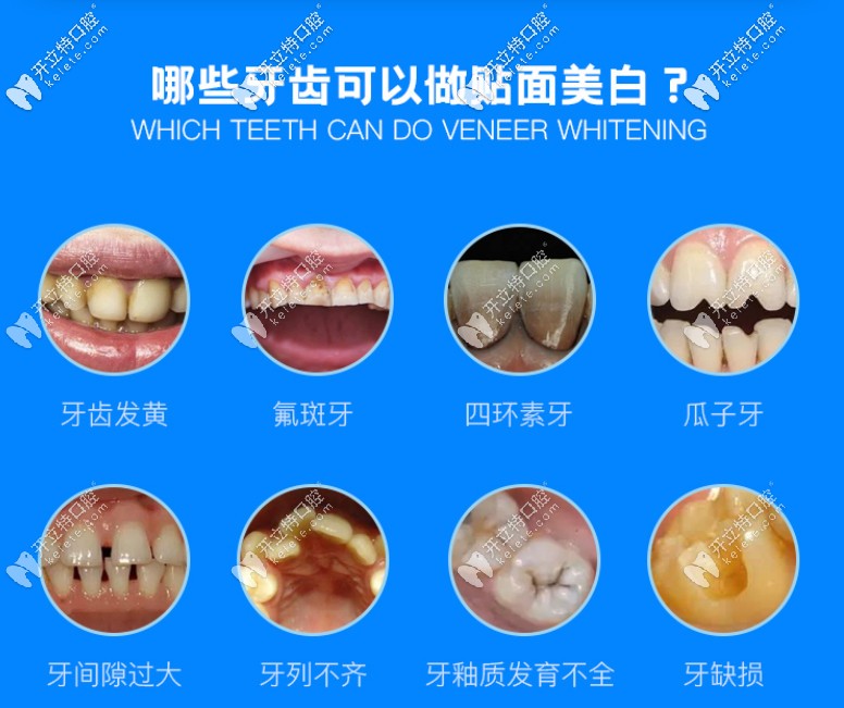那些牙齒可以做貼面美白修復