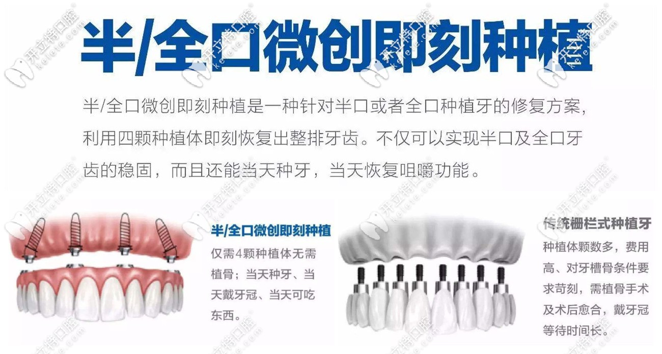 半/全口微創(chuàng)即刻種植技術的特點