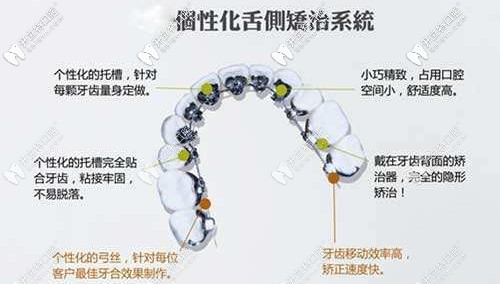 個(gè)性化舌側(cè)矯正系統(tǒng)的特點(diǎn)