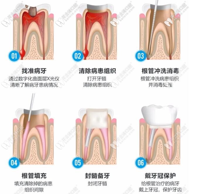 顯微鏡根管治療術(shù)過(guò)程的步驟