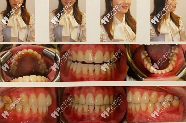 整牙的時間不長，但是<span style=