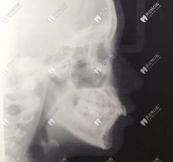側(cè)面X光，門牙唇傾很厲害的