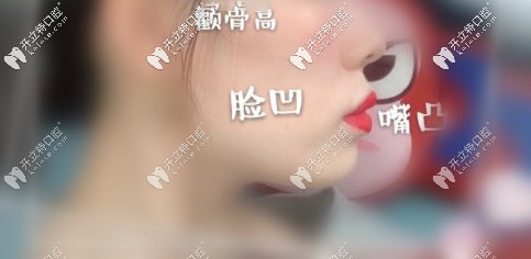 顴骨高、面部凹陷、凸嘴
