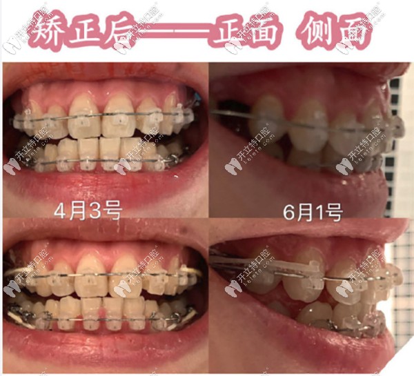 陶瓷半隱形矯正2個月