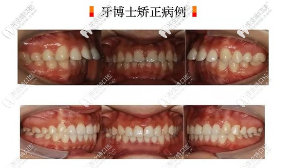 長春超龍牙博士口腔做瑞士進口隱形矯正案例