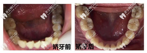 矯牙前后對比