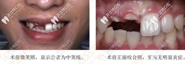 前牙美學區(qū)做韓國奧齒泰TSIII SA即刻種植牙的真人案例