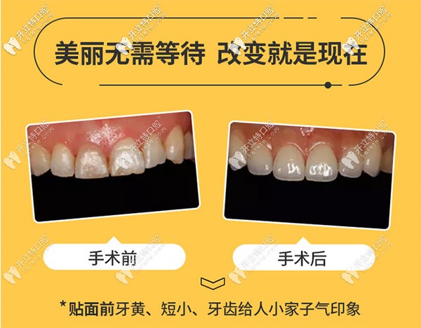 為美發(fā)問(wèn)：重慶渝中區(qū)的美奧口腔做美加超薄牙貼面如何？