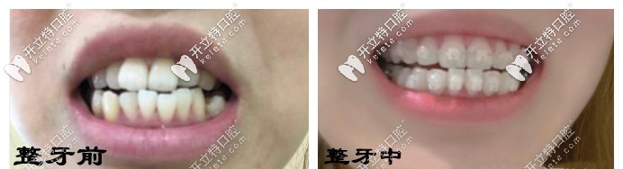 整牙前后對比