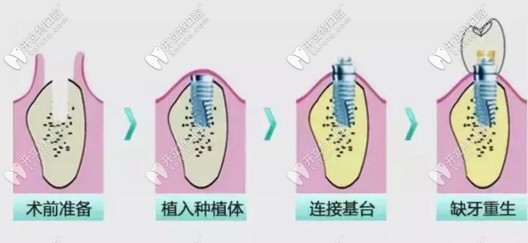 種植牙過程