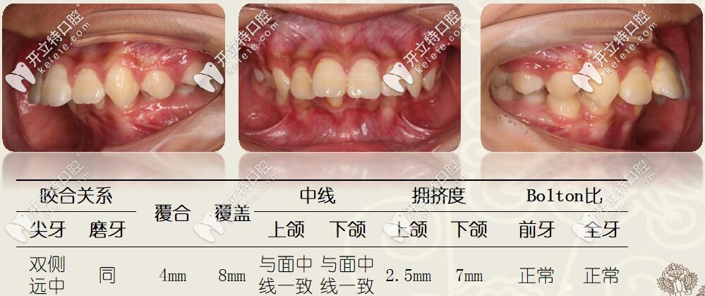 圣貝牙科，兒童矯治案例