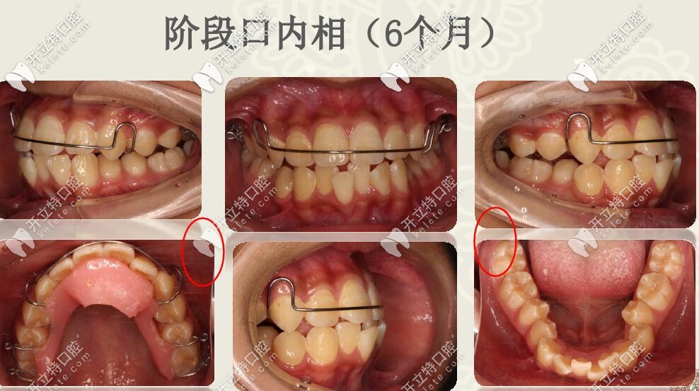 線圣貝口腔肌功能結(jié)合擴弓矯治案例