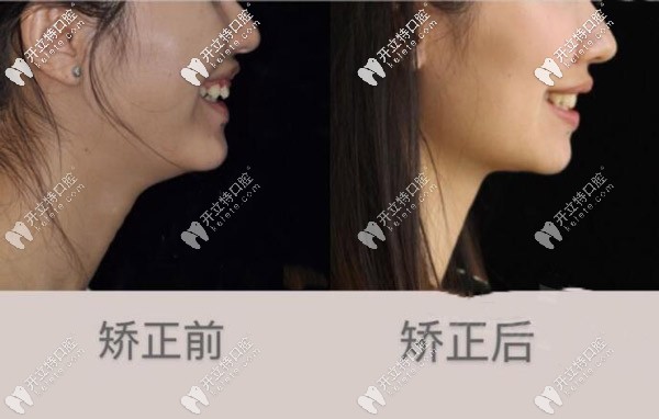 矯正后側(cè)面圖