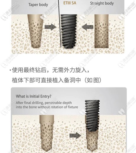 美國皓圣ETIII SA種植體的優(yōu)勢