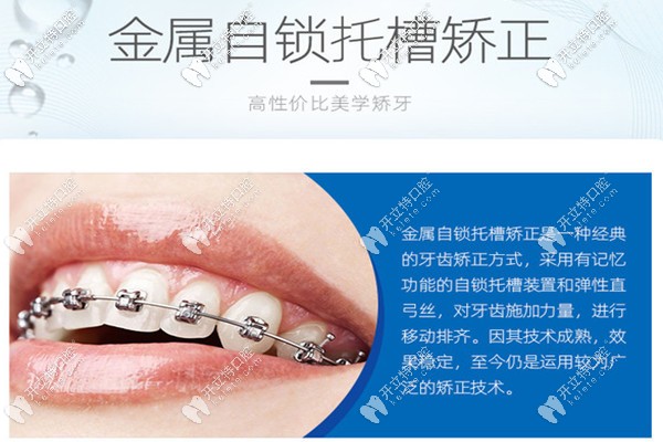 西安團圓口腔自鎖托槽整牙技術(shù)