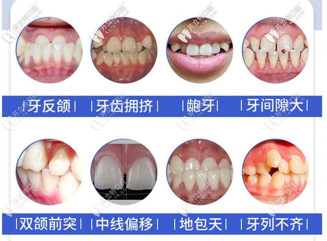 想知道重慶時(shí)代天使矯正價(jià)格嗎？世紀(jì)美奧口腔活動(dòng)價(jià)19800