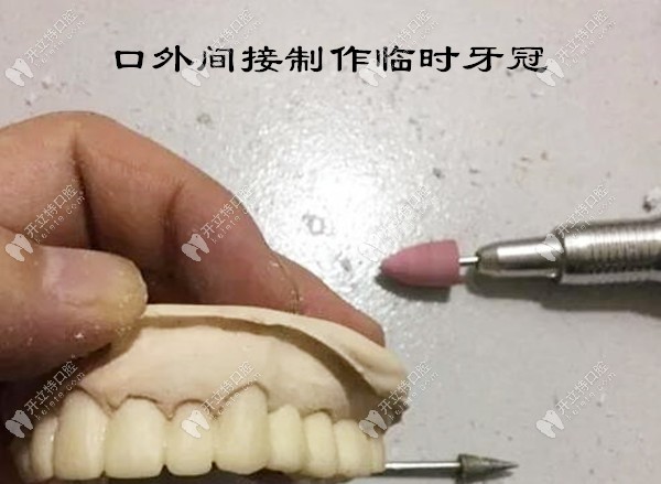 口外間接制作臨時(shí)牙冠