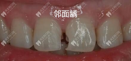 鄰面齲