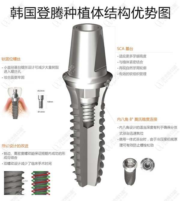 在曙光電子做韓國登騰進口種植體信息