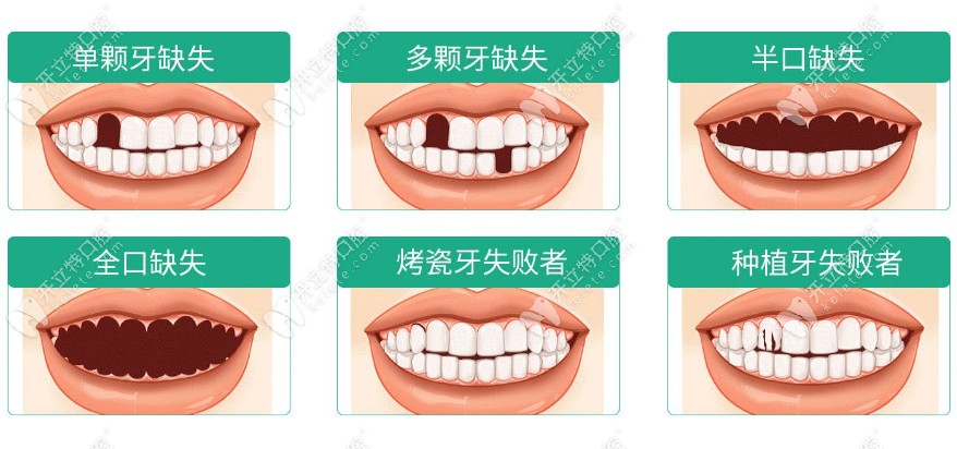珠海九龍口腔韓國(guó)進(jìn)口種植牙適應(yīng)癥