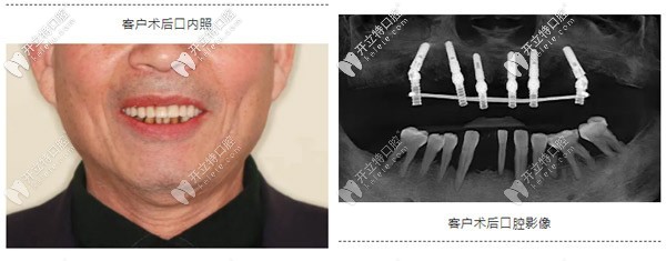 典型重度牙周炎種植案例:如何實(shí)現(xiàn)即刻種植與即刻修復(fù)？